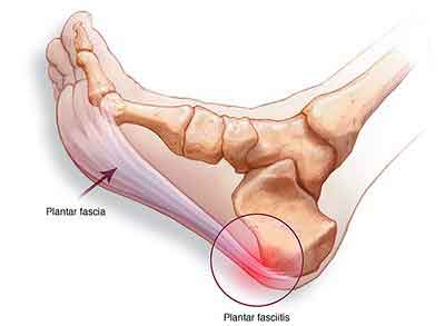 Causes of Plantar Fasciitis Foot Pain