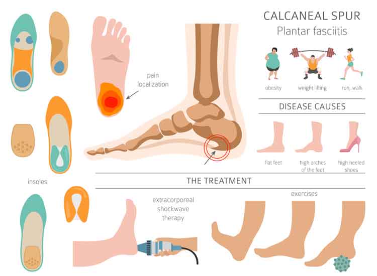Plantar Fasciitis Foot and Heel Pain Relief: Plantar Fasciitis Pain in ...